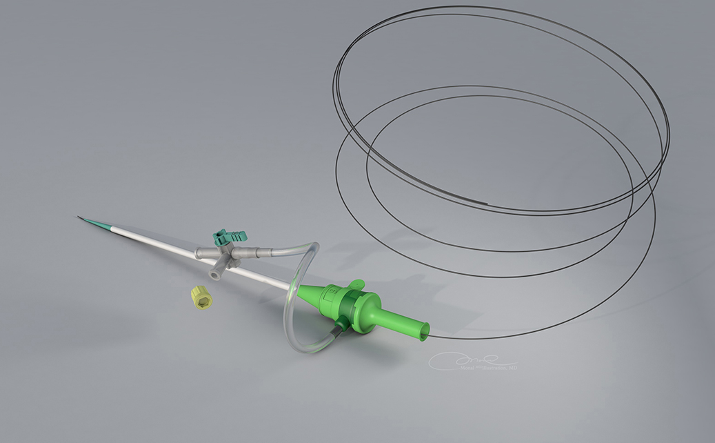 3D Terumo sheath with guidewire Co24 Monal
