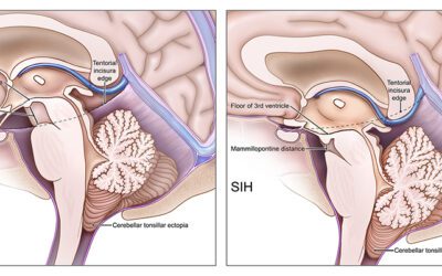 Lydia Gregg’s Work Featured on Cover of Journal of Neurosurgery