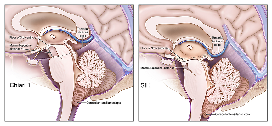Lydia Gregg’s Work Featured on Cover of Journal of Neurosurgery