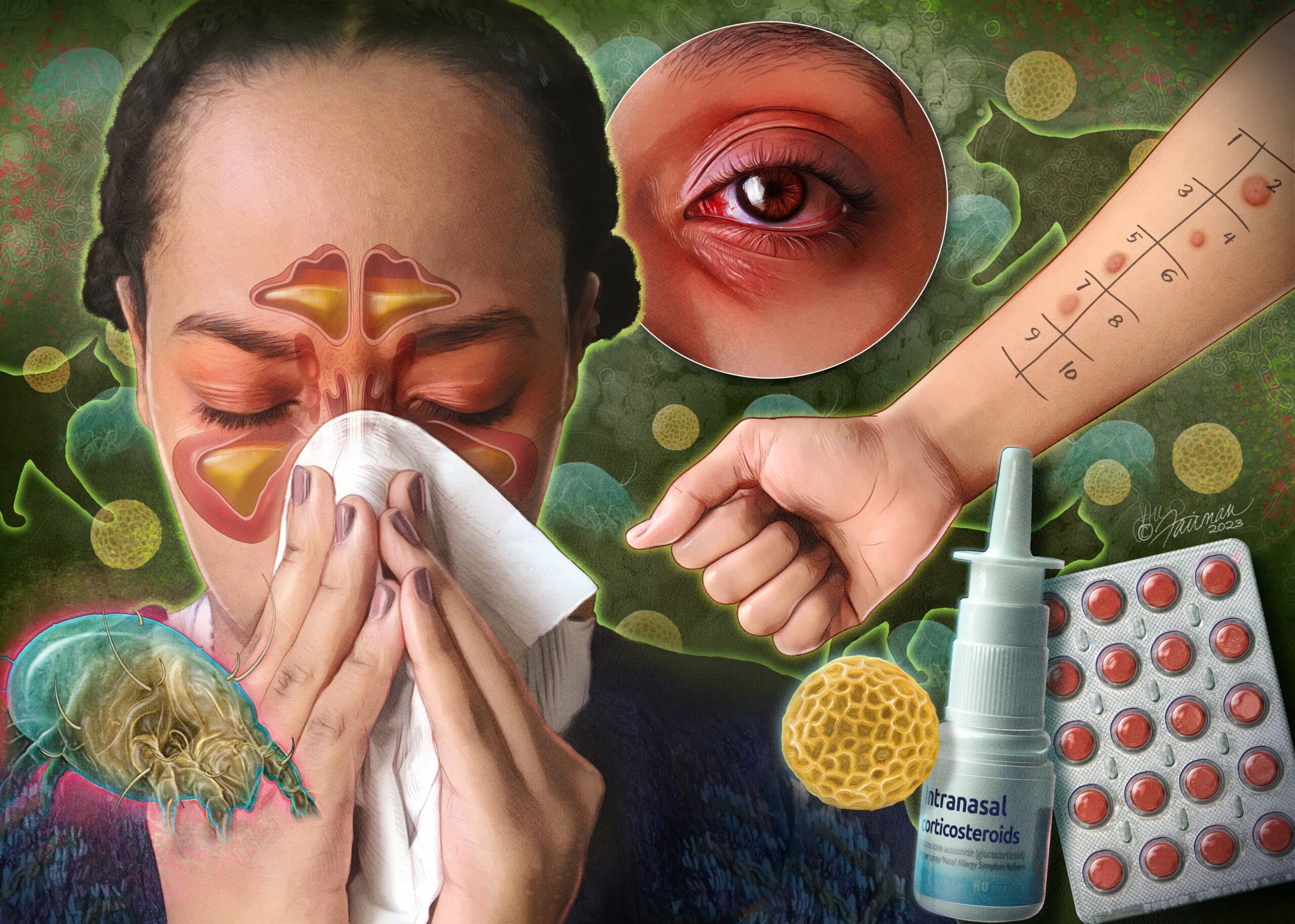 Fairman AllergicRhinitis scaled