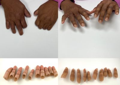 Finger Prostheses
