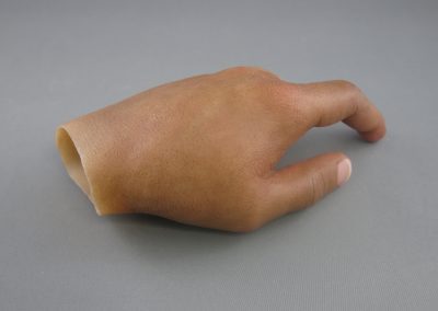 Hand Prosthesis Dorsal 1 scaled