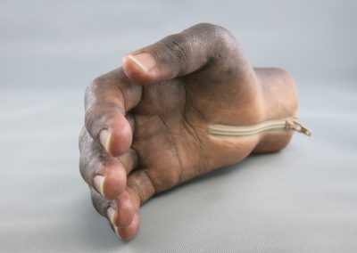 Hand Prosthesis Palmar Zip scaled