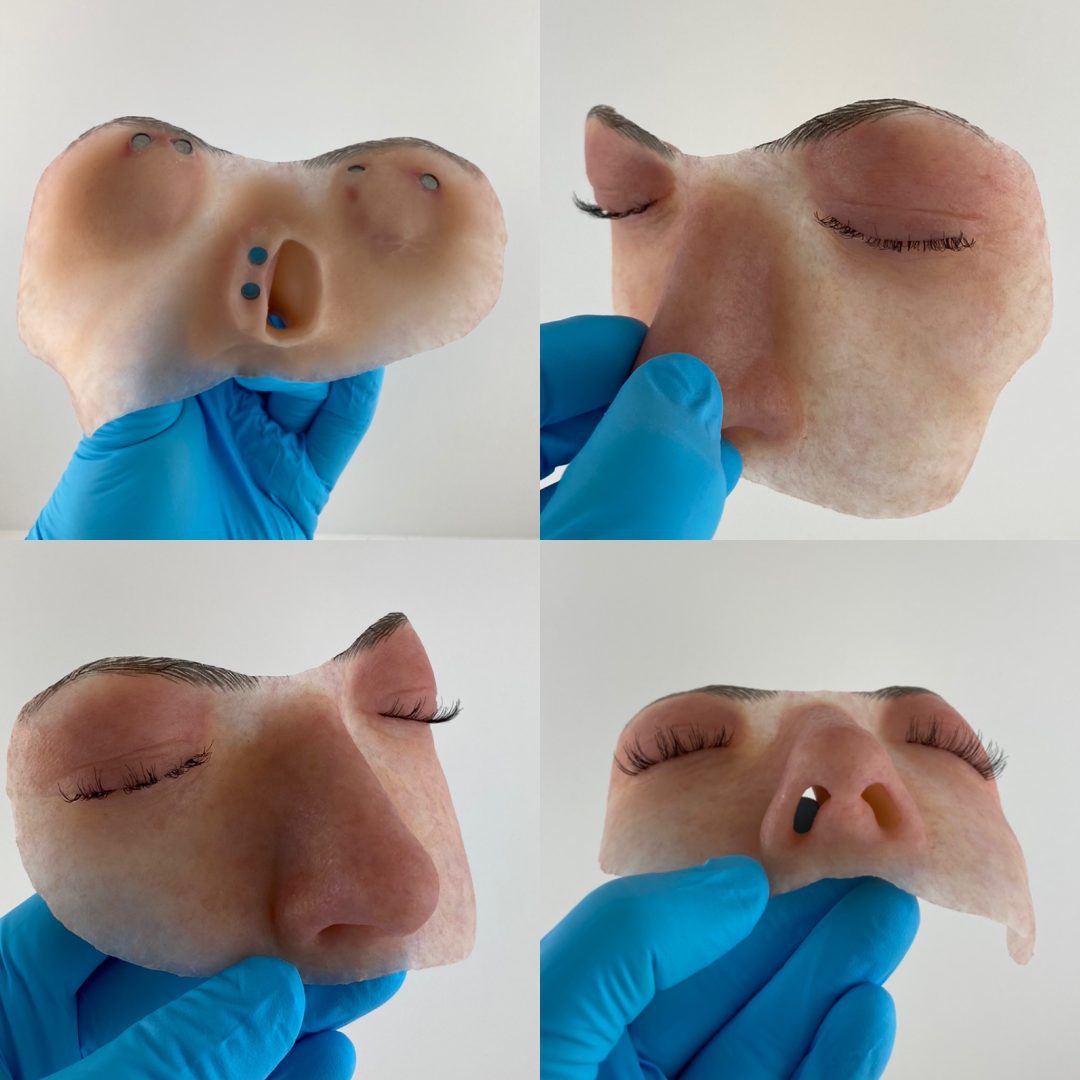Hemifacial Prosthesis