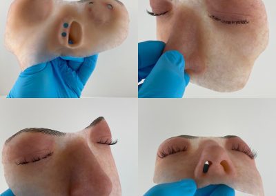 Hemifacial Prosthesis