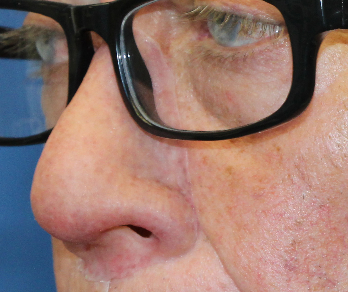 Nasal Prosthesis 2