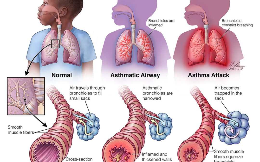 Asthmatic Airways