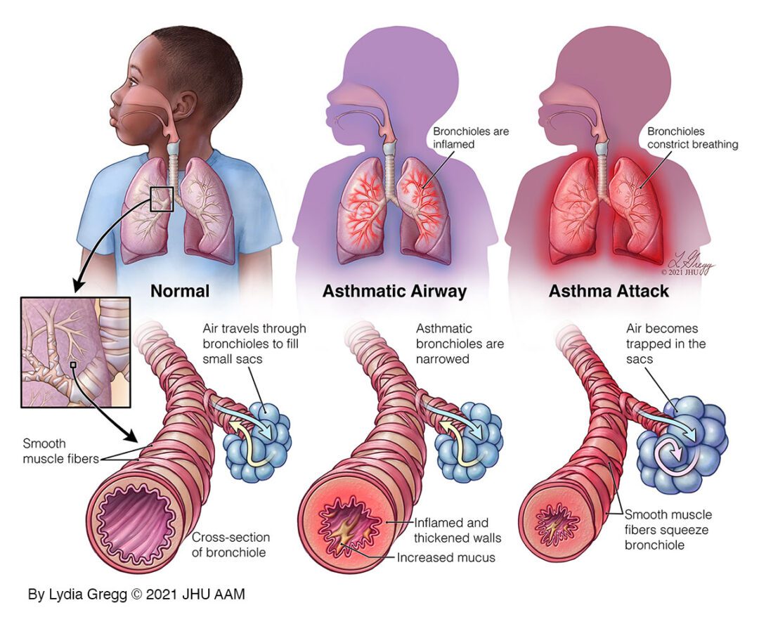 Lydia Gregg Asthmatic bronchiole 2021