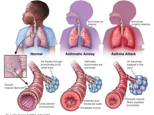 Asthmatic Airways