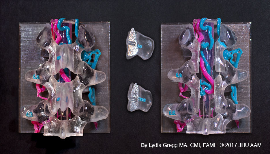Lydia Gregg Perimedullary spinal REPLACE
