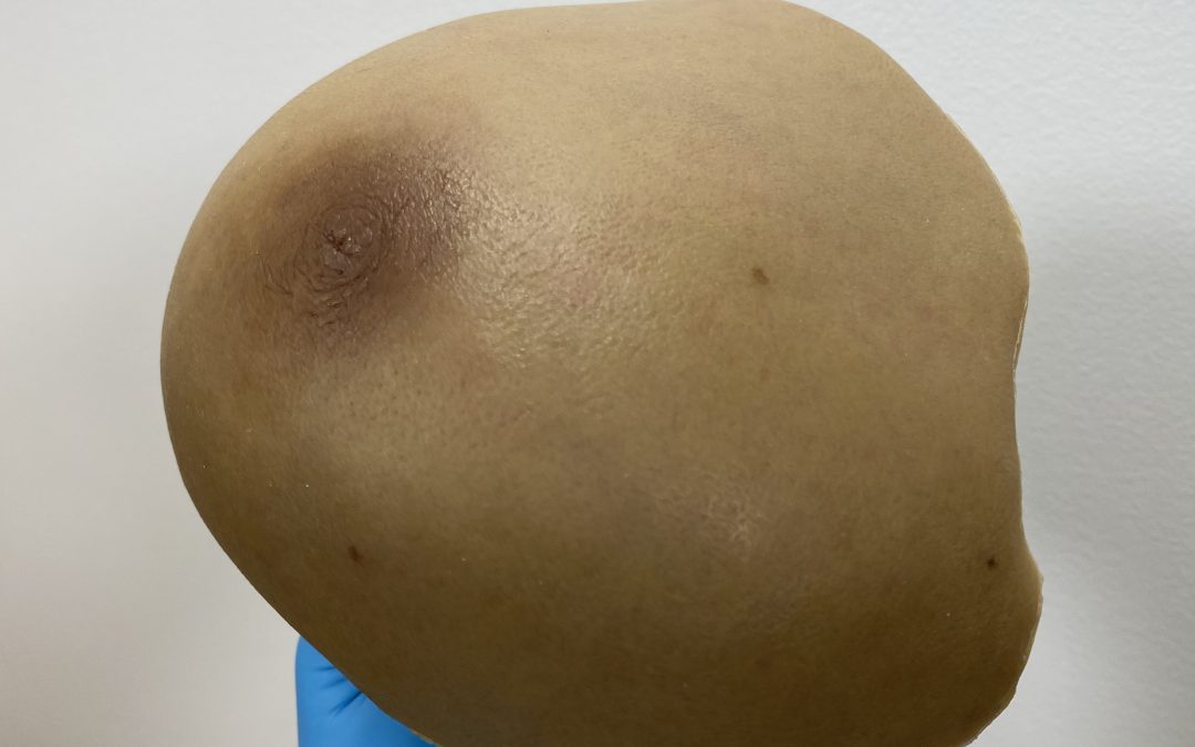 Mastectomy Prosthesis