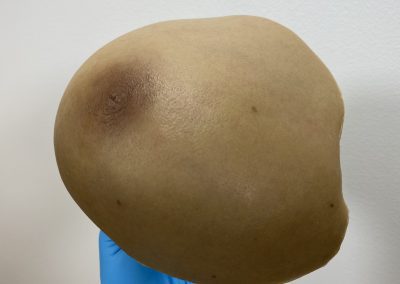 Mastectomy Prosthesis scaled