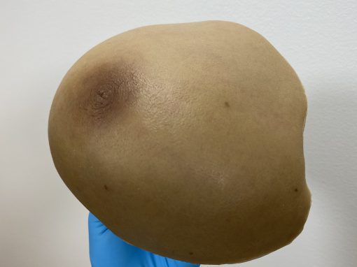 Mastectomy Prosthesis