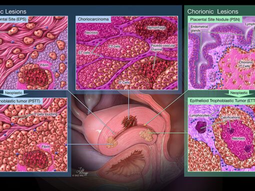Placental Cancers