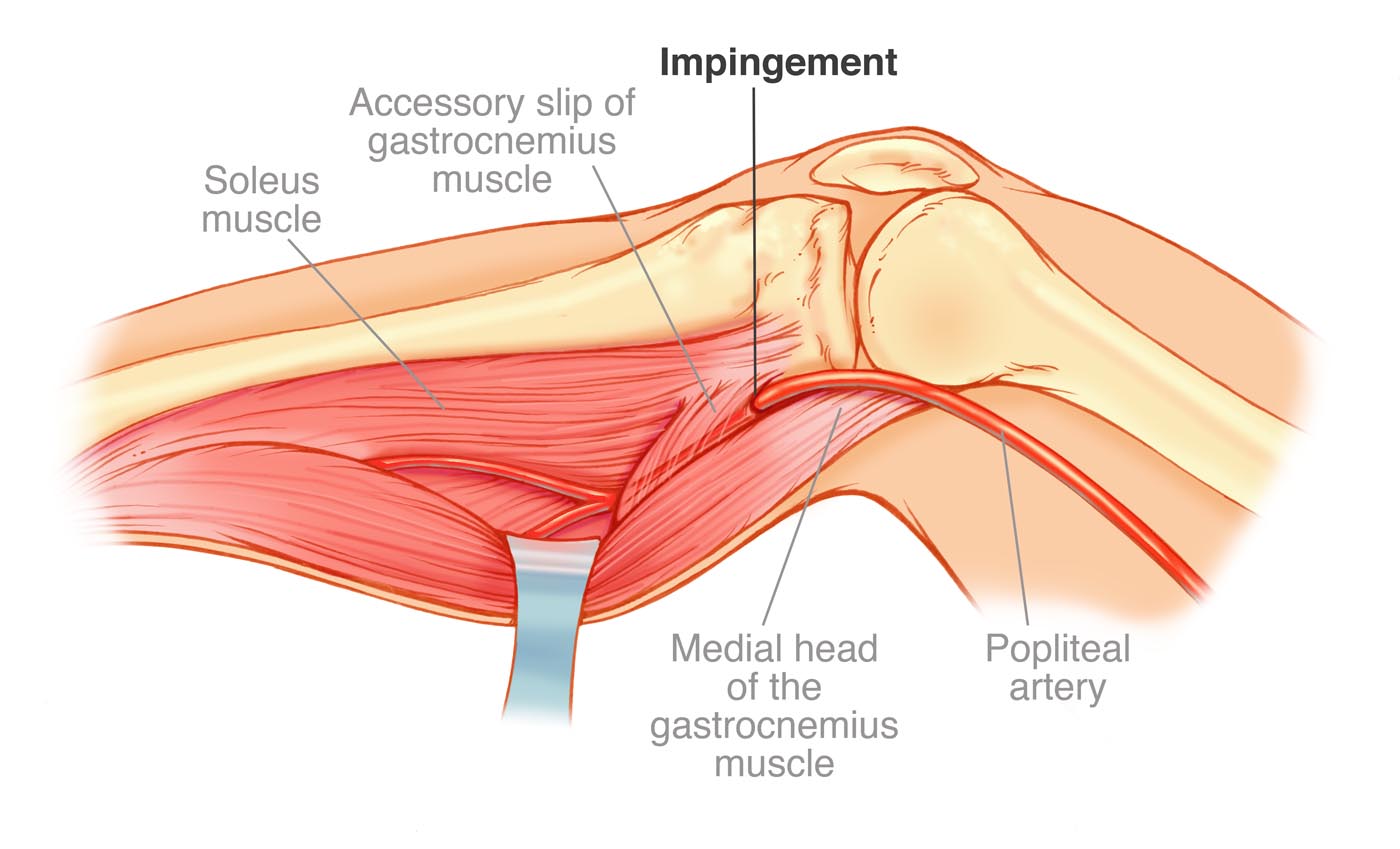 Popliteal Exposure color