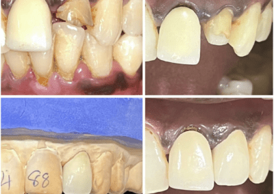 SampleDentalProsthetic1 SMandal