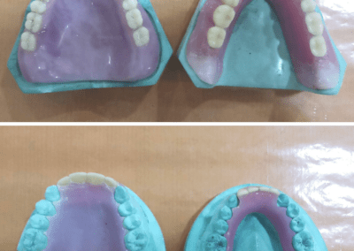 SampleDentalProsthetic2 SMandal
