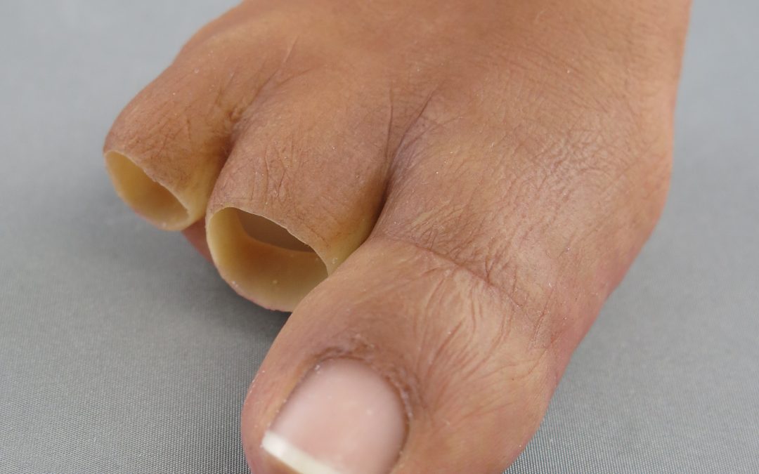 Toe Prosthesis