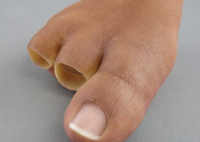 Toe Prosthesis 1 scaled