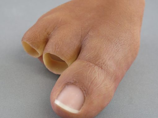 Toe Prosthesis