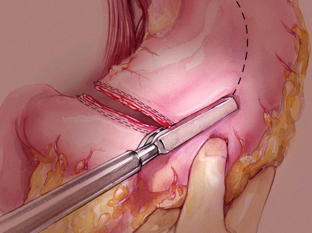 Hand assisted laparoscopic surgery (HALS)