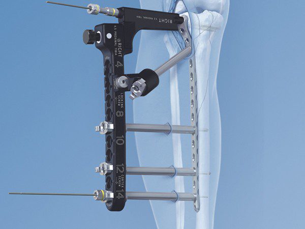 Surgical Guide for Tibial Fracture Fixation