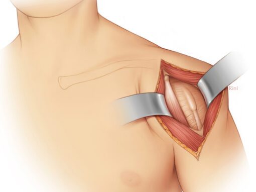 Surgical Exposure of the Anterior Shoulder