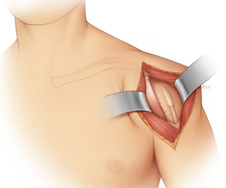 Surgical Exposure of the Anterior Shoulder