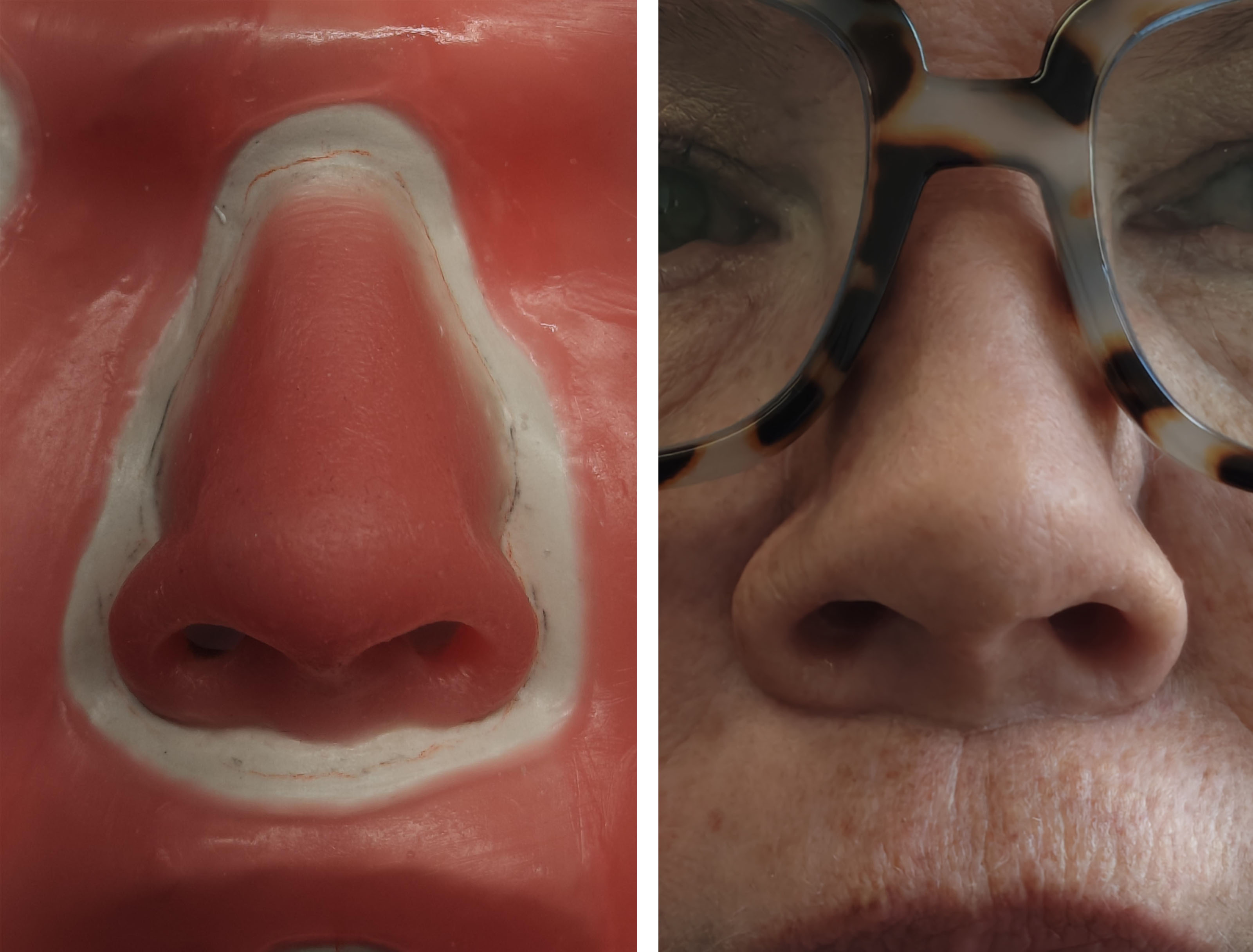 Nasal Prosthesis